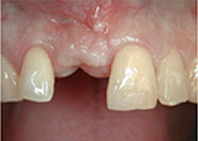 dental-1-tooth-lost