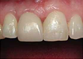 dental-2-tooth-crown