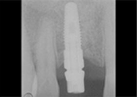 dental-3-tooth-xray