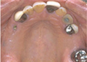 dental-4-fillings-decay