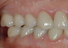 dental-6-natural-teeth