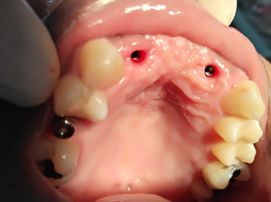 dental-8-dental-implants