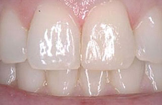 composite-bonding-after