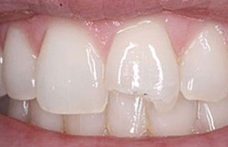 composite-bonding-before